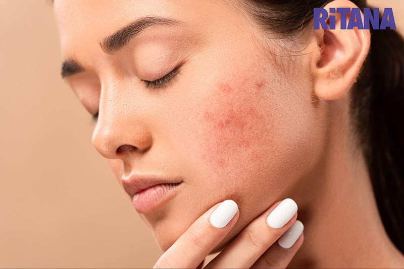 Da bị kích ứng khi trẻ hóa da