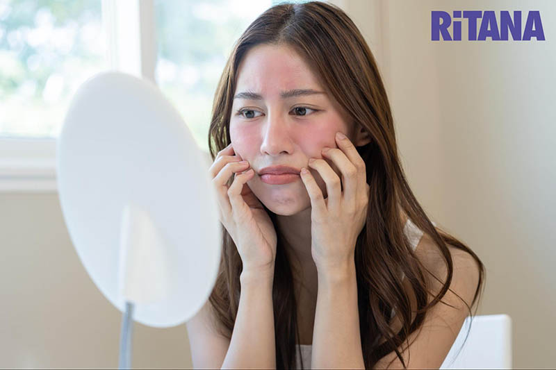 Da sau khi điều trị nám bằng laser