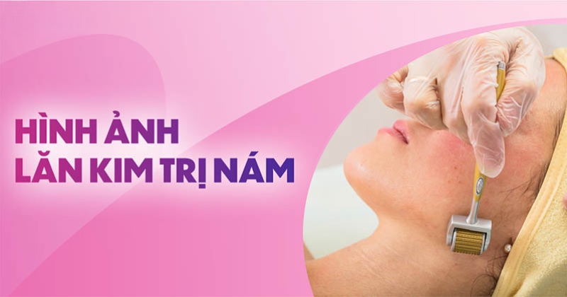 hình ảnh lăn kim trị nám