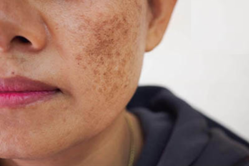 hình ảnh nám chân sâu trên mặt