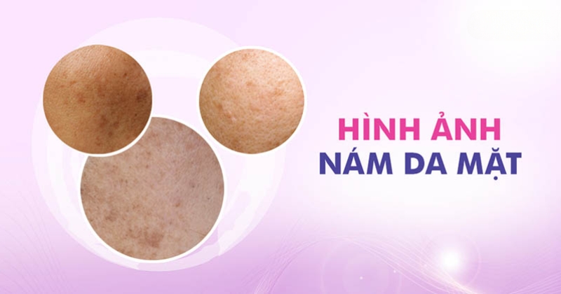 hình ảnh nám da mặt