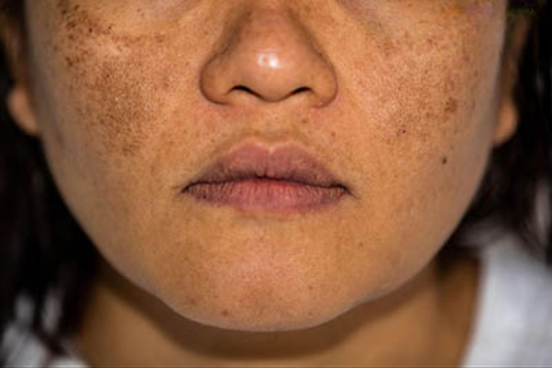 hình ảnh nám hỗn hợp