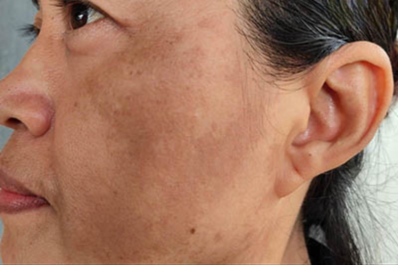 hình ảnh nám mảng trên mặt