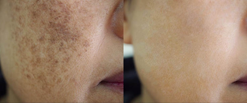 ảnh sau lăn kim trị nám