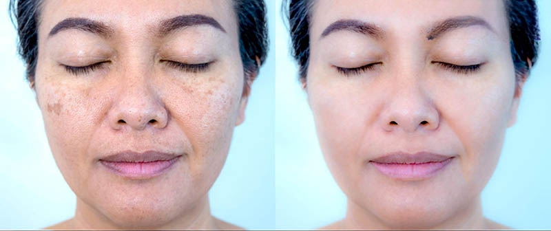 ảnh trước sau lăn kim trị nám