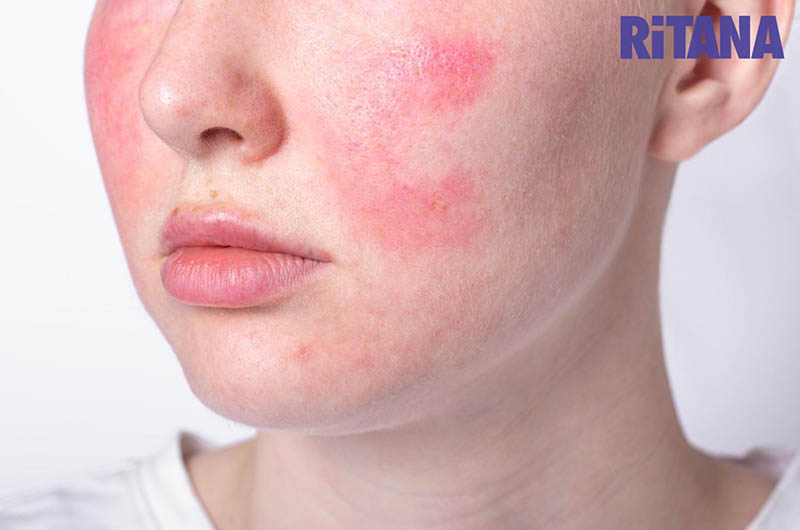 Tác hại của việc điều trị nám bằng laser