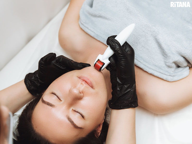Công nghệ lăn kim trị nám da
