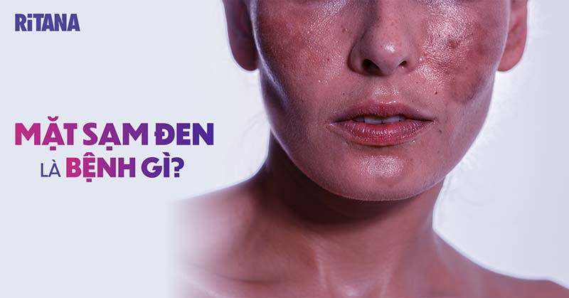 Da bị sạm đen là bệnh gì? Nên điều trị như thế nào cho hiệu quả?