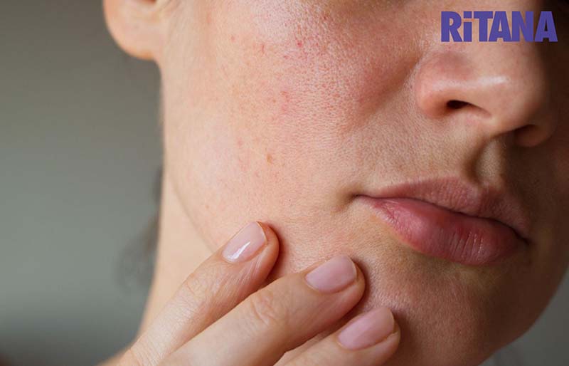 Da mặt bị sạm đen do không chăm sóc da đúng cách