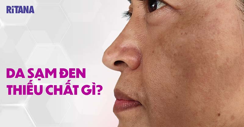 Da sạm đen thiếu chất gì? Cách cải thiện như thế nào?
