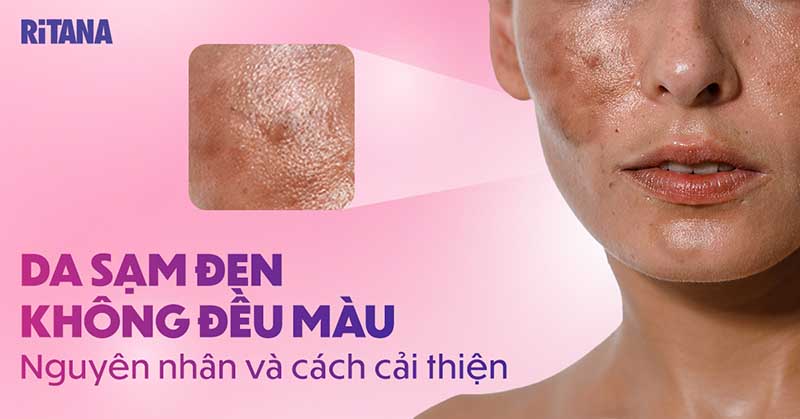 Da sạm đen không đều màu: Nguyên nhân và cách cải thiện