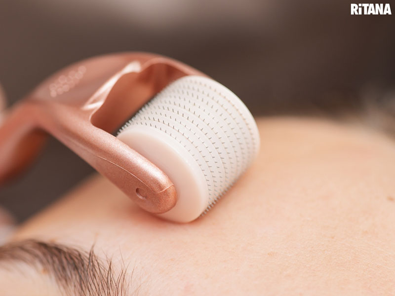 Phương pháp lăn kim trị nám có tốt không