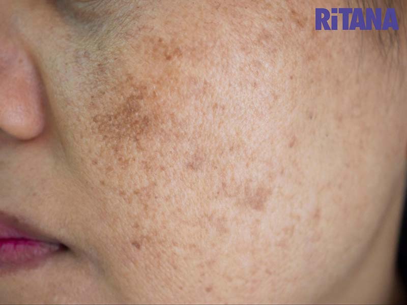 Rối loạn nội tiết nguyên nhân gây ra nám chân đinh
