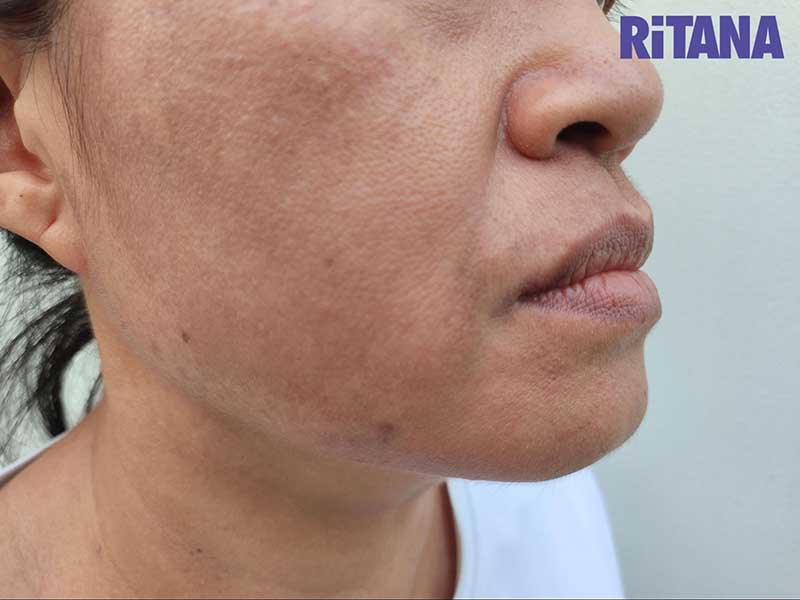 Tác hại của da bị sạm đen Tác hại của da bị sạm đen