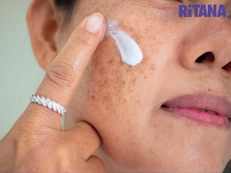 Thoa kem trị nám chân sâu