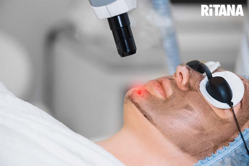 Trị sạm đen da bằng laser