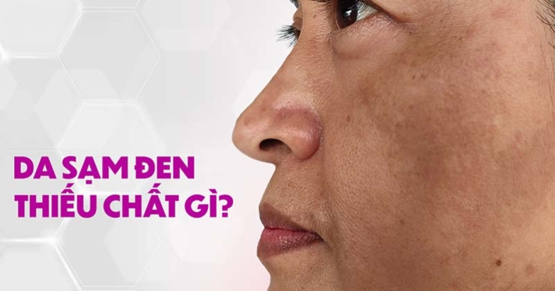 Da sạm đen thiếu chất gì? Cách cải thiện như thế nào?
