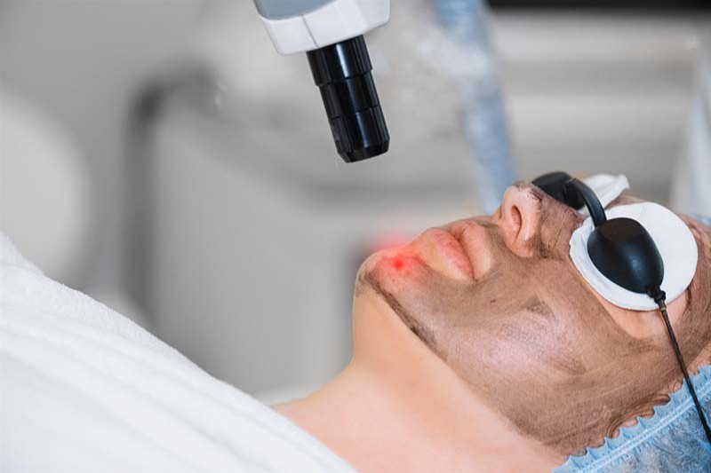 trị da sạm đen bằng laser