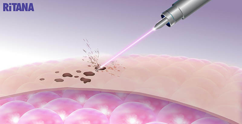 Cơ cấu bắn tia laser điều trị tàn nhang