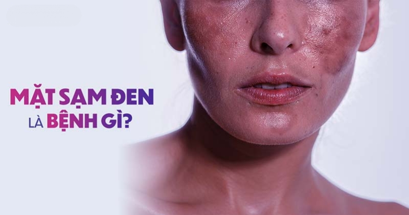 Da bị sạm đen là bệnh gì? Nên điều trị như thế nào cho hiệu quả?