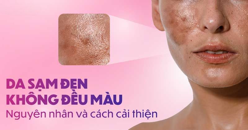 Da sạm đen không đều màu: Nguyên nhân và cách cải thiện