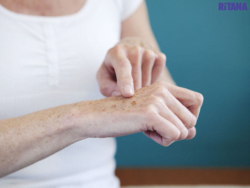 Đồi mồi bắt đầu hiện khi da bị lão hóa