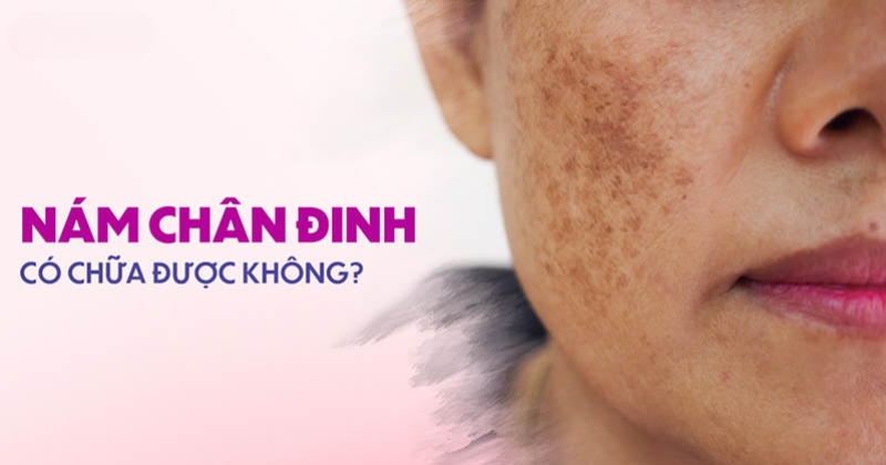 Nám chân đinh có chữa được không? Dứt điểm hoàn toàn không?