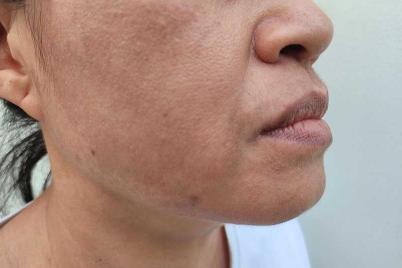 tác hại của da sạm đen không đều màu