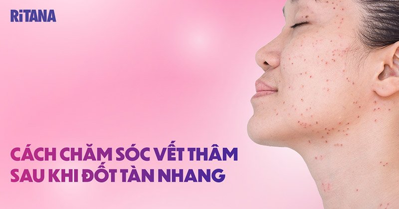 Cách chăm sóc vết thâm sau khi đốt tàn nhang mang lại hiệu quả cao