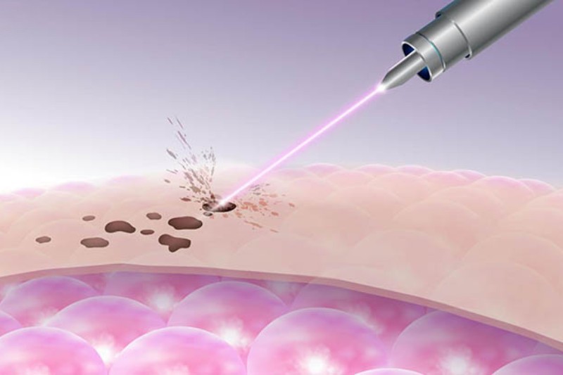 cơ cấu bắn tia laser trị tàn nhang