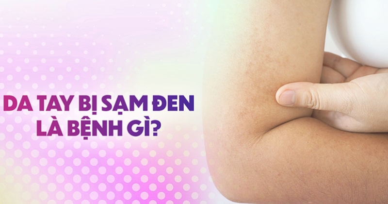 Da tay bị sạm đen là bệnh gì? Nên điều trị như thế nào?