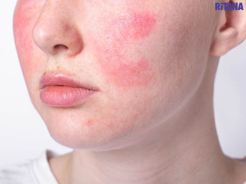 Da thường đỏ và ngứa sau quá trình laser