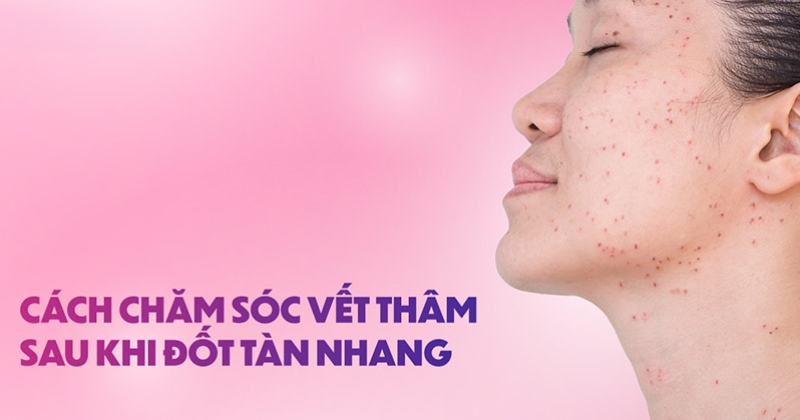 cách chăm sóc vết thâm sau đốt tàn nhang