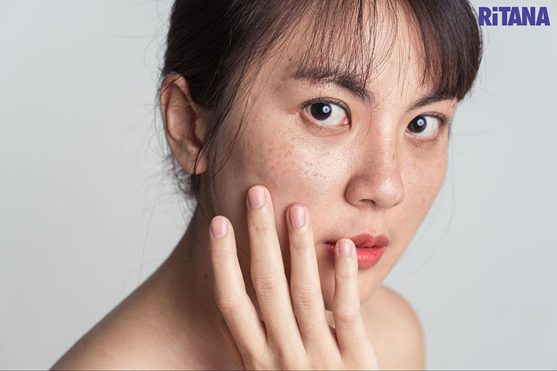 Nguyên nhân gây ra tàn nhang