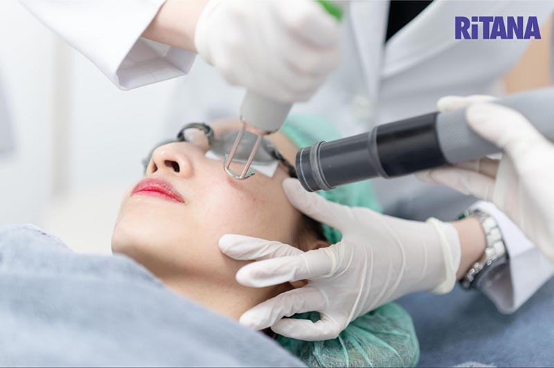 Bắn laser giúp ức chế melanin