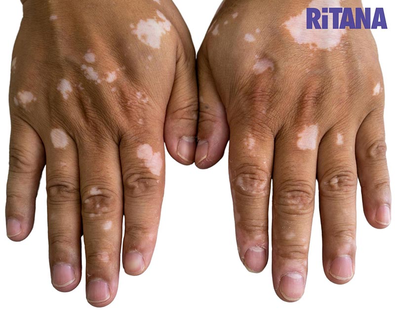 da bị rối loạn sắc tố-mất sắc tố