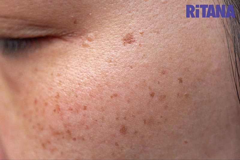 Hình ảnh da bị rối loạn sắc tố - tàn nhang