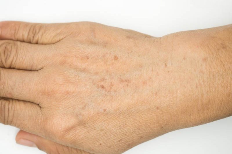 da tay bị sạm là do melanin sản sinh quá mức