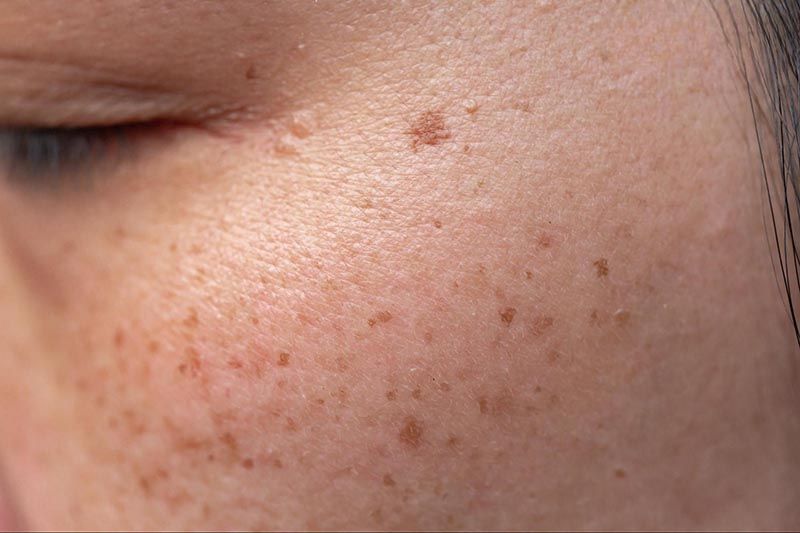 hình ảnh tàn nhang do rối loạn sắc tố da