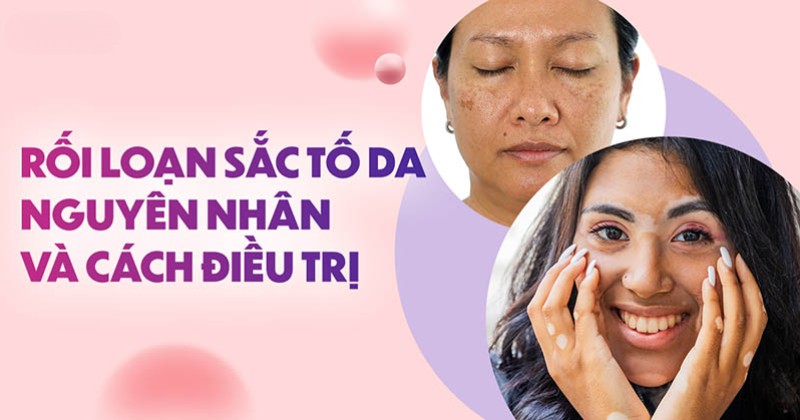 Rối loạn sắc tố da: Cách điều trị và nguyên nhân mắc bệnh