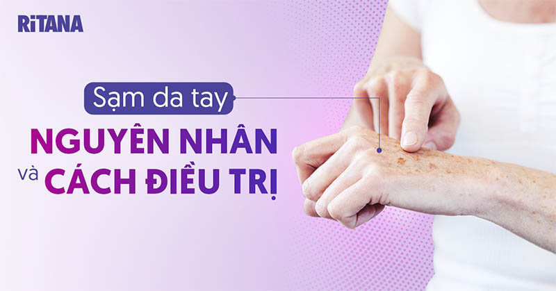 Bị sạm da tay: Nguyên nhân và cách điều trị như thế nào?