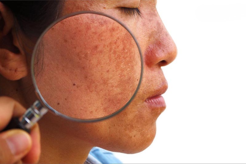 tăng sắc tố da gây nám