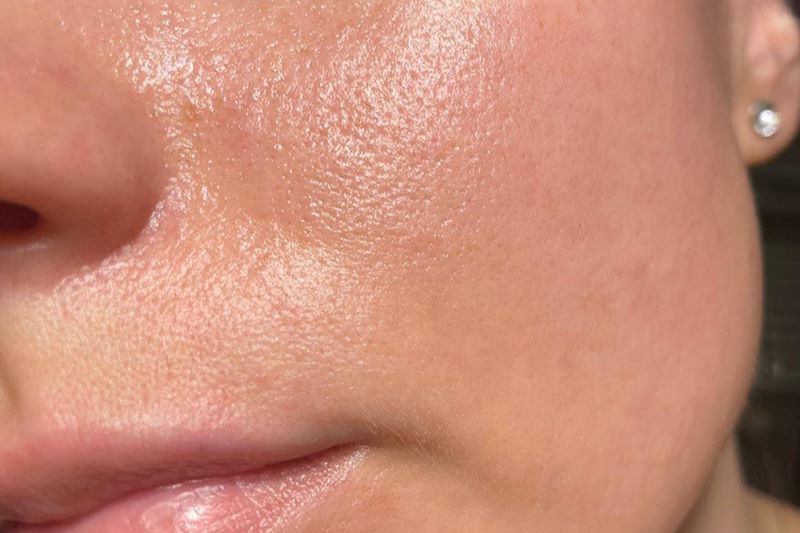 da dầu có lỗ chân lông to