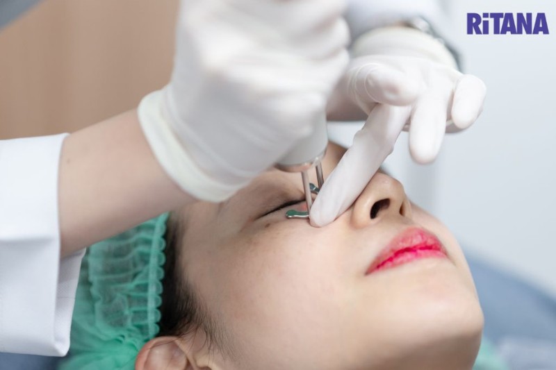 công nghệ Laser picosure là trị nám