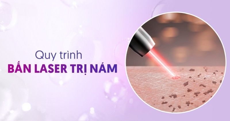 Quy trình bắn laser trị nám chuyên nghiệp mang lại hiệu quả cao