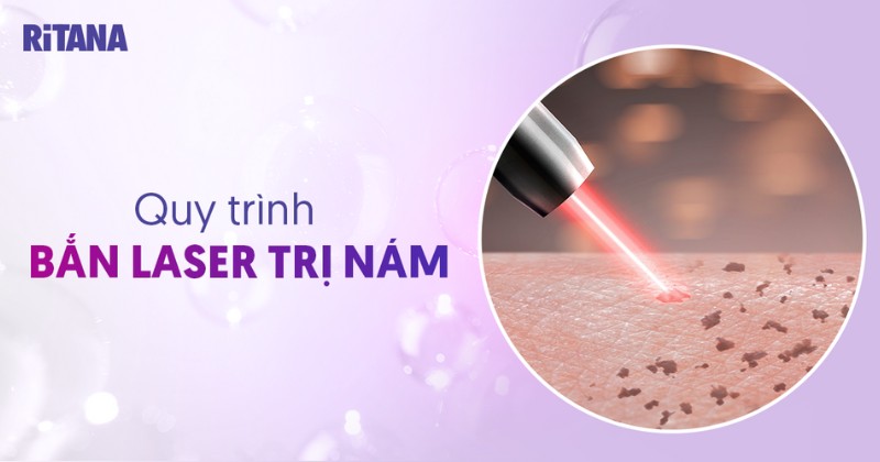 quy trình bắn laser trị nám
