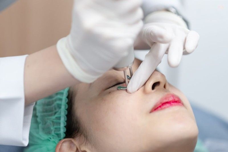 trị nám bằng laser picosure
