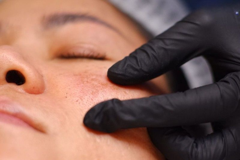 vết châm chim của nám da