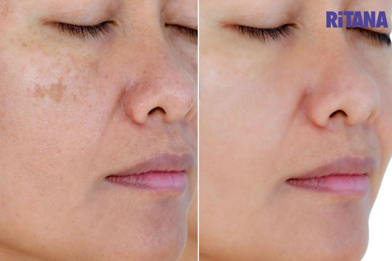 tiêm meso hỗ trợ làm mờ sạm nám