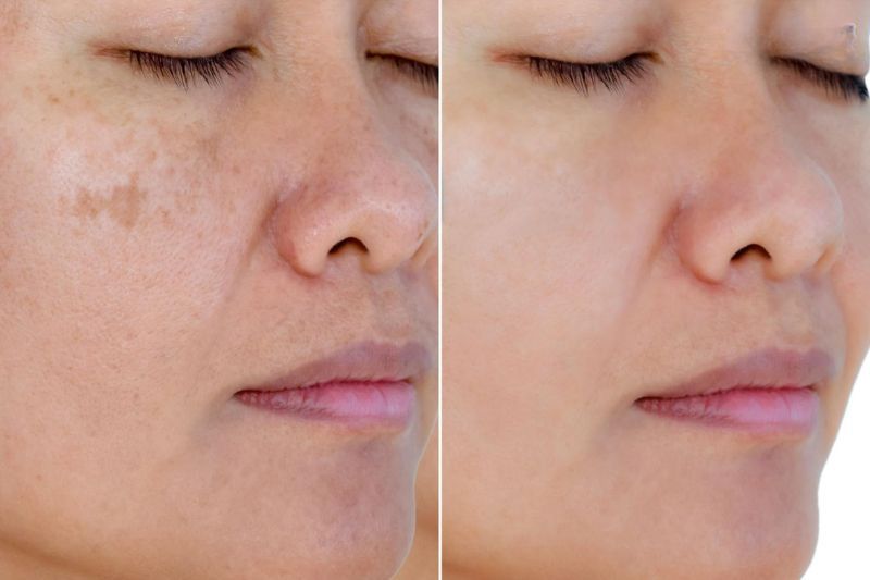 hình ảnh trước và sau khi tiêm meso trị nám